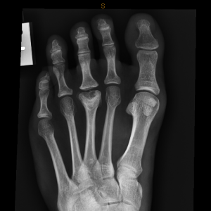 Foot pain xray