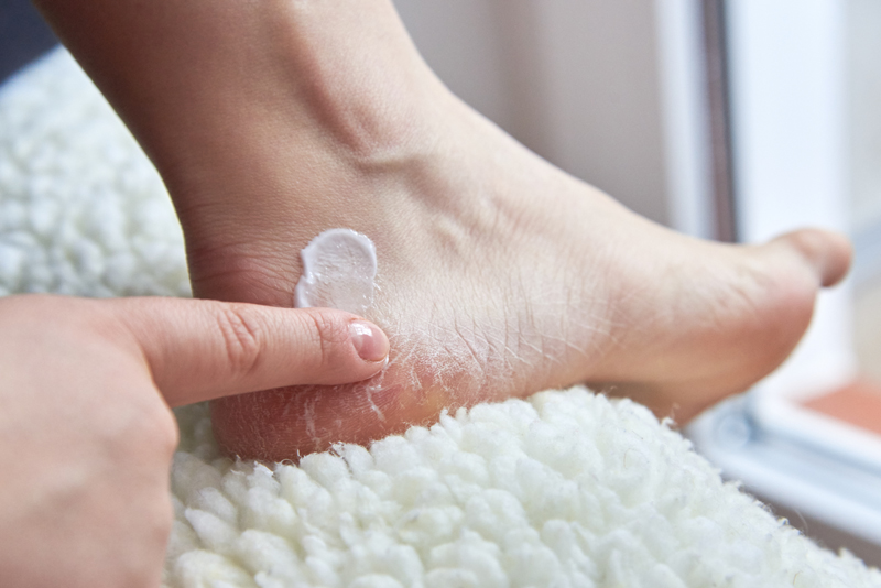 Girl smears moisturizing cream on dry feet covered 