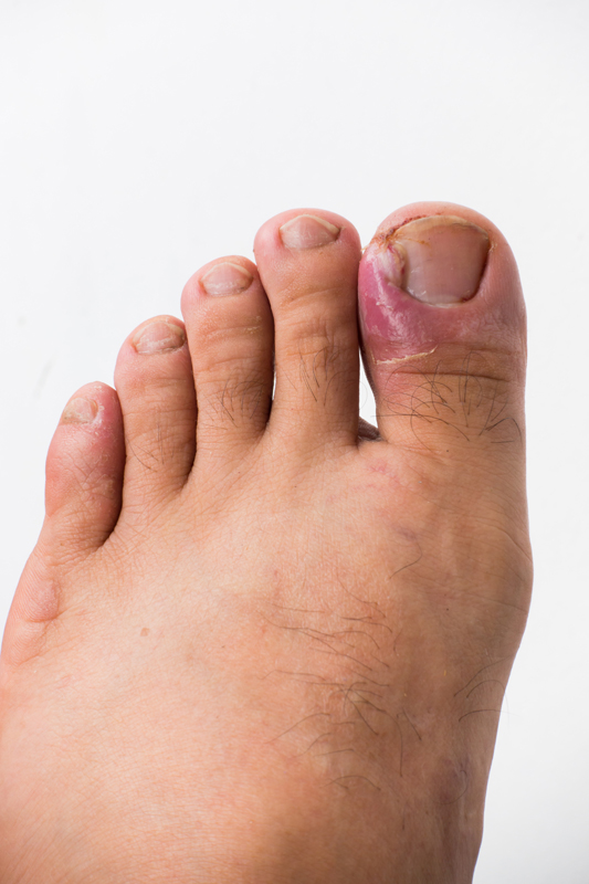 Close up of ingrown toenail 