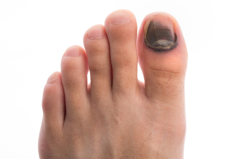 Bleeding under the toe nail