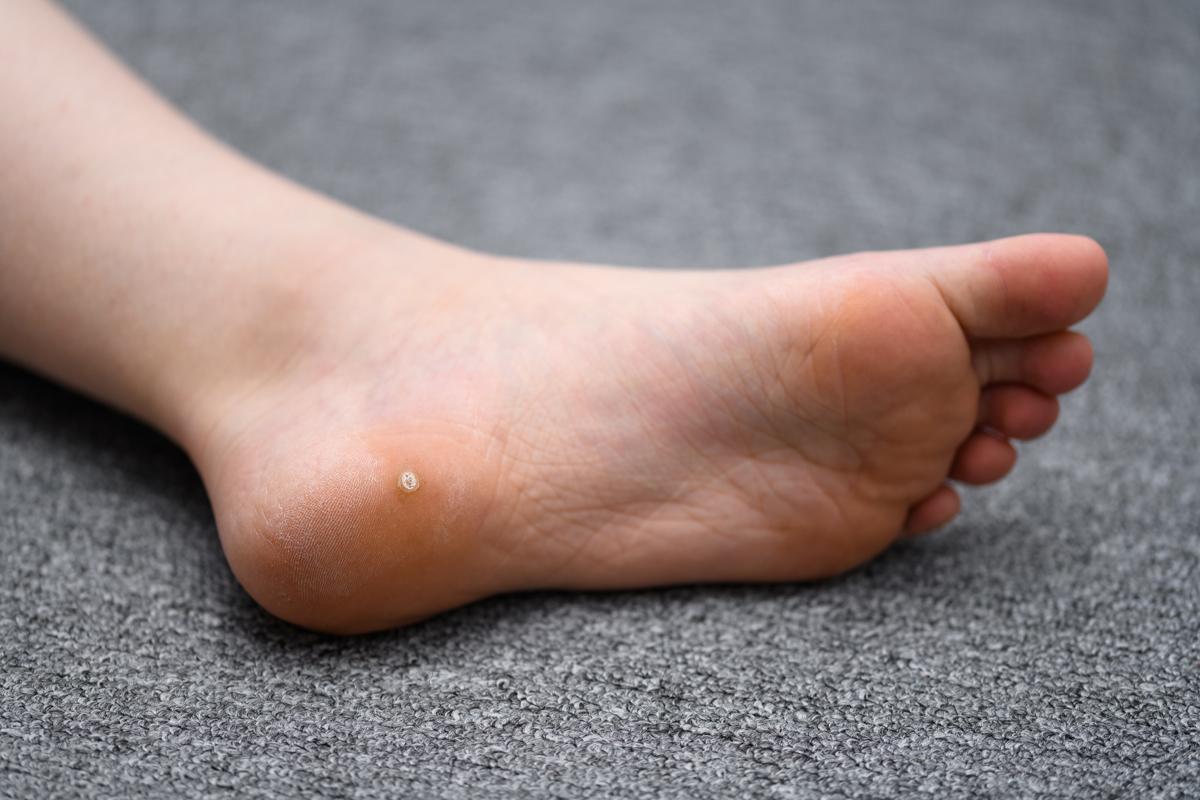 Foot wart, verrucas plantar on the foot of a child.